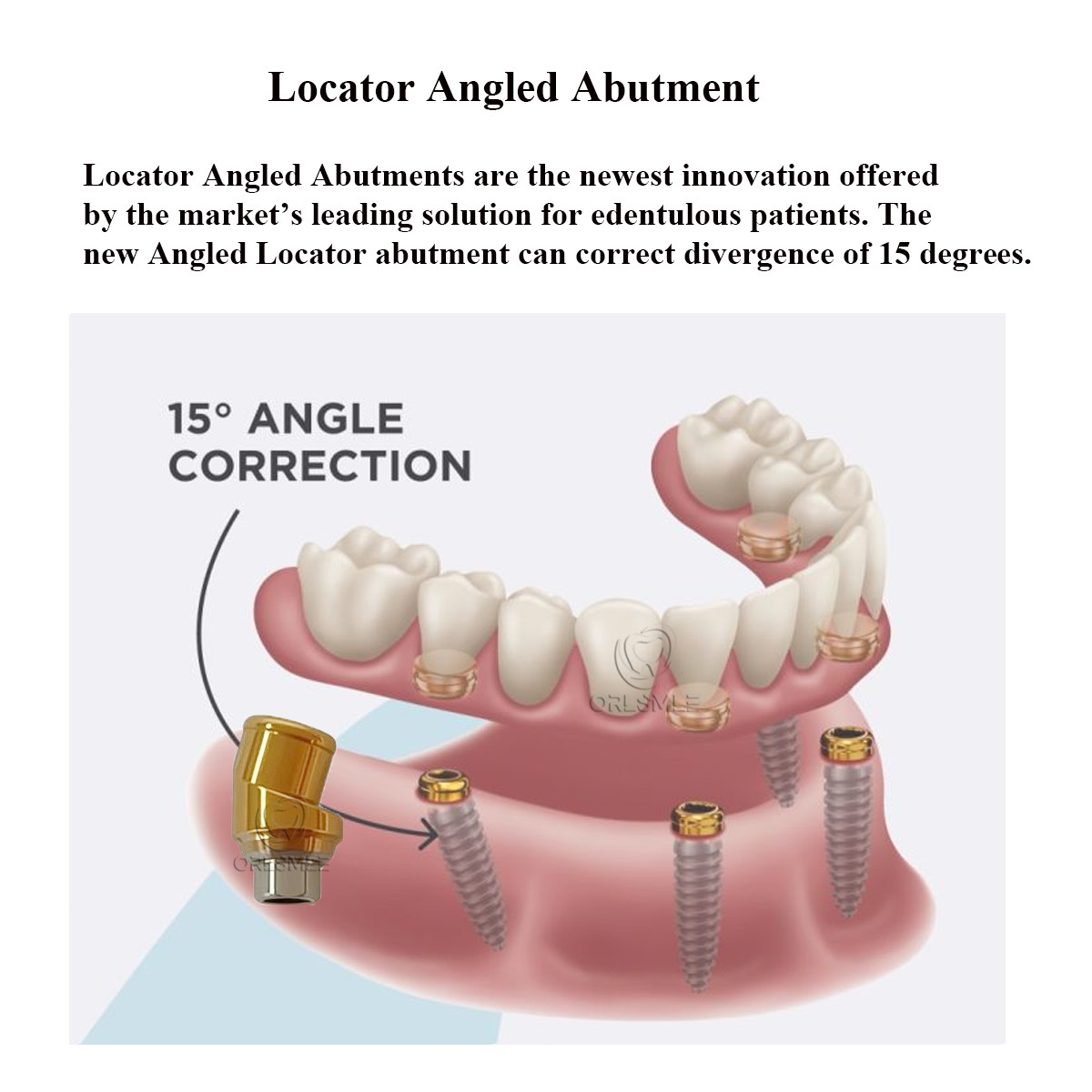 15° Angulated Locator Overdenture Abutment fit to Cortex(Dynamix) GH1.5/3.0mm