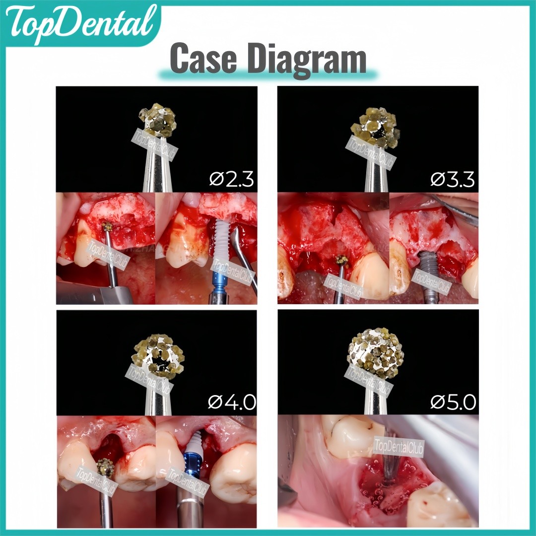 Dental Degranulation Burs Kit Bone Debridement Remove Tissue Debris Remnant Bur