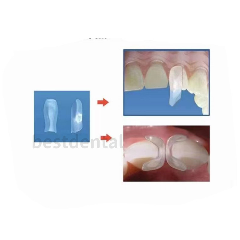 1.901 Mixed Sizes Dental Clear Matrix Anterior Matrices Bow BT Fits Bioclear
