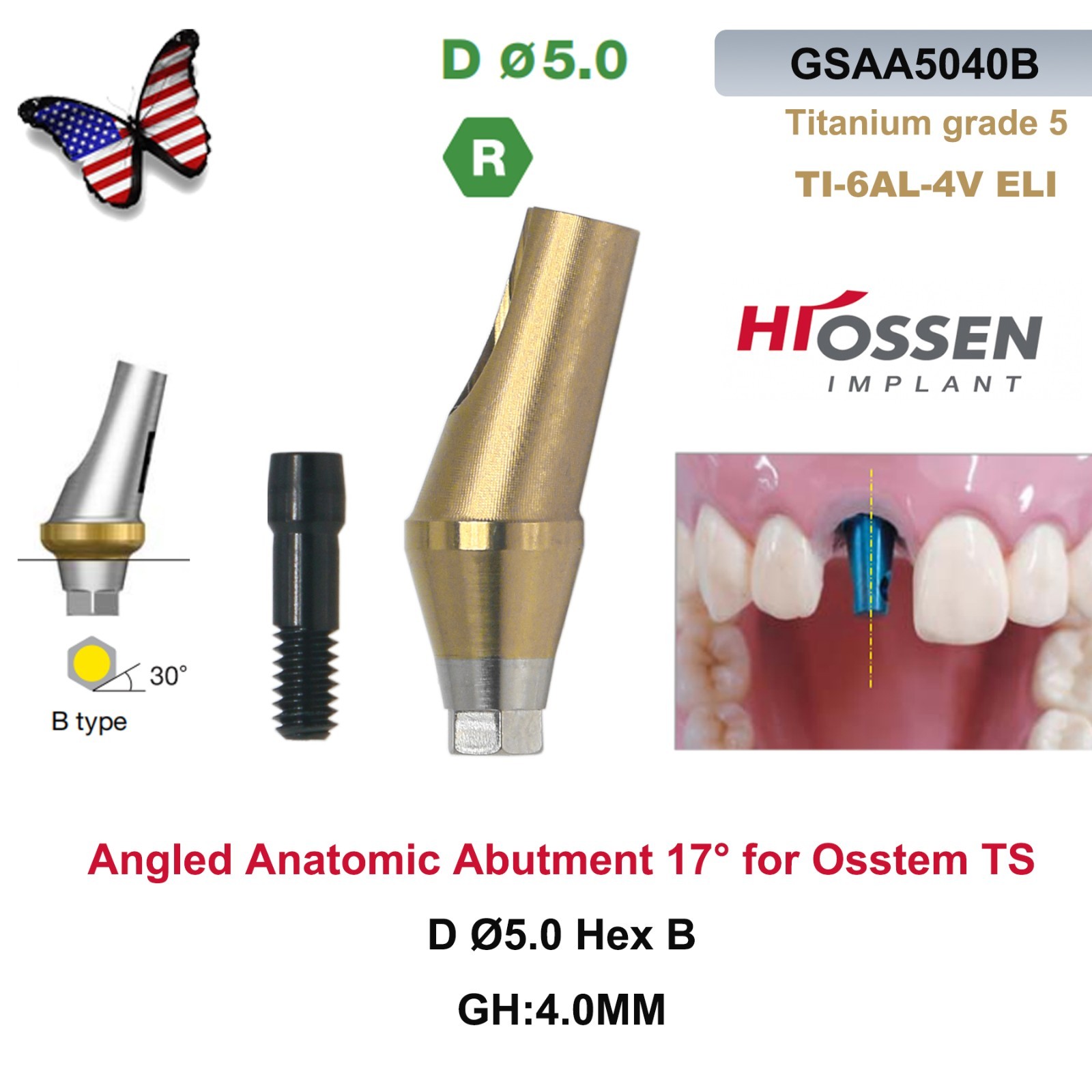 US 17° Dental Angled Anatomic Abutment Hex Compatible with Hiossen ET/Osstem TS