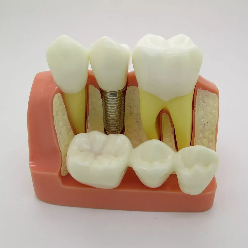 2Pc Dental Oral Analysis Crown Bridge Demonstration Tooth 4 Times Model Typodont
