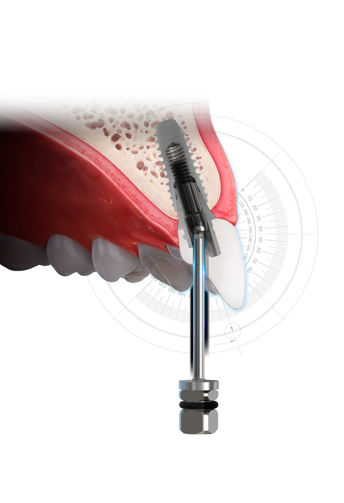 ASC Driver Angulated Screw Channel Driver for Hiossen 3i Nobel MIS Astra Implant
