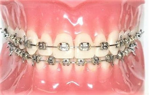 SS Twin Brackets, Roth, .018, 20/Kit, Modern Arch