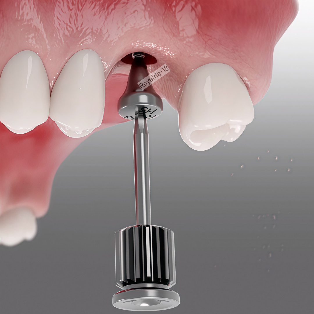 Dental Caps Healing Abutment/Lab Analog Mini Regular Platform Fits ostem Hiossen