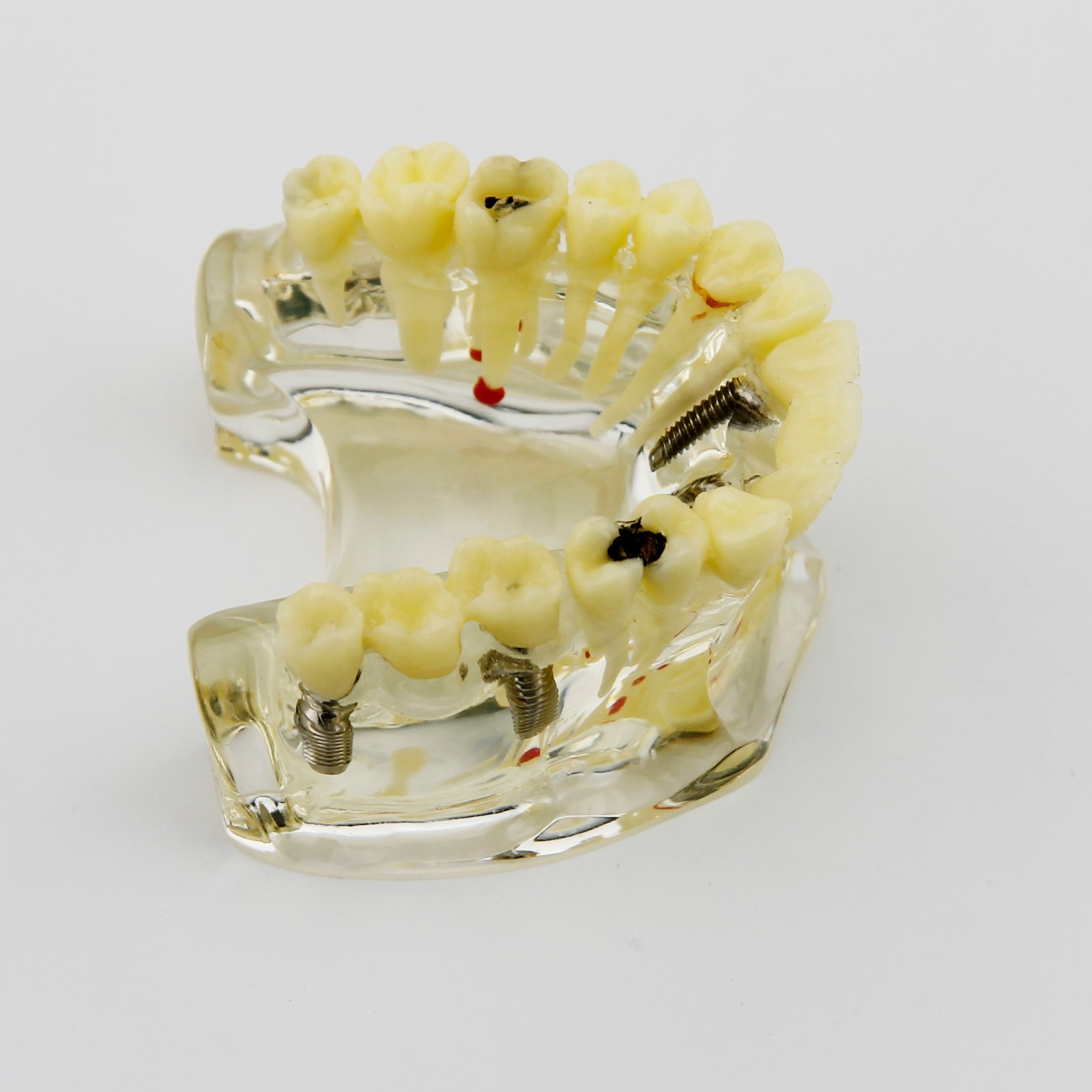 Dental Upper Jaw Implant Model with Bridge and Caries -I 2006