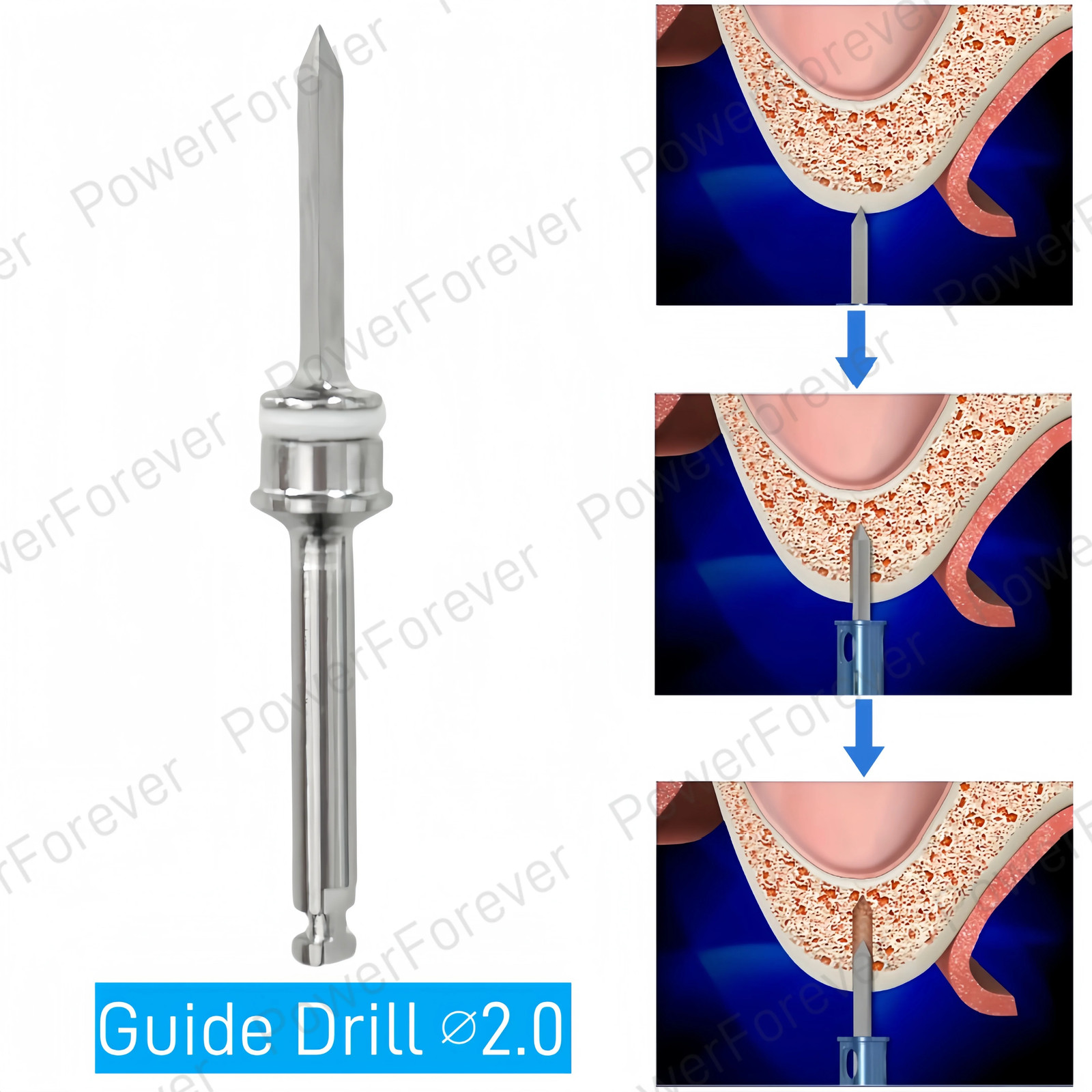 Dental Maxillary Sinus Lift Membrane Water Rising Hydraulic Lifter Aqua Tip Wate