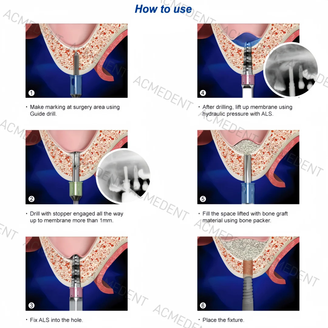 Dental Maxillary Sinus Lift Membrane Water Rising Hydraulic Lifter Aqua Tip Wate