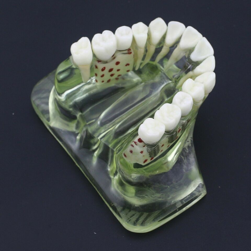 Dentist Student Tool Dental Model Upper Jaw With Crown Bridge