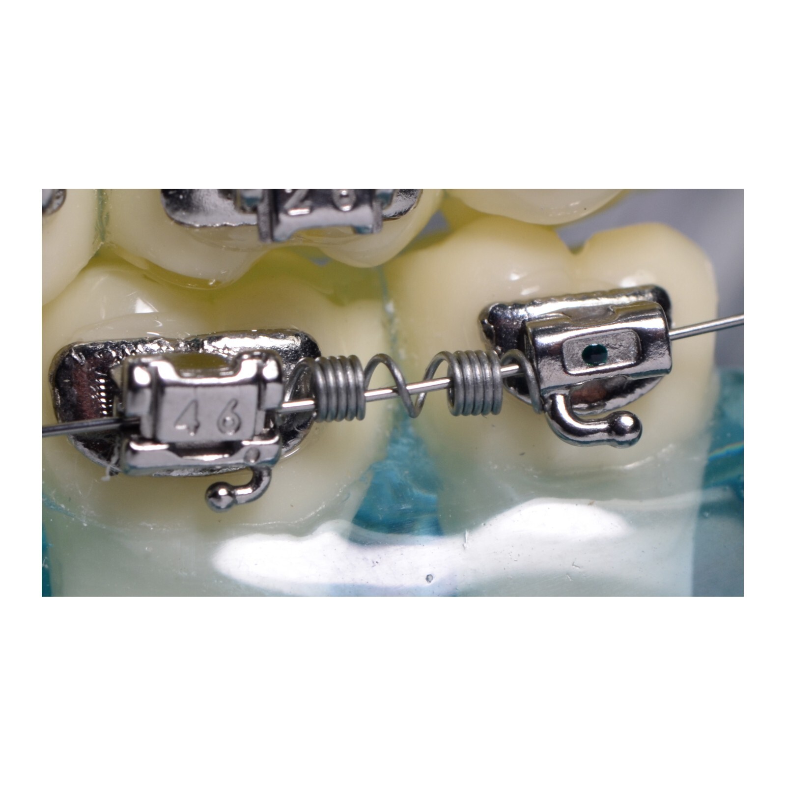 J&J Ortho™ Orthodontic Open & Closed NiTi Distalizing Coil Spring 180mm*10