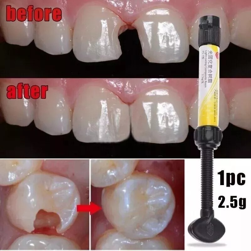 Dental Composite Resin Light Cure White Veneer Hybrid Aesthetic teeth resin 2.5g