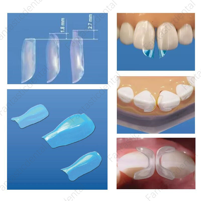 30Pcs Dental Clear Matrix Front Teeth Anterior Matrices BT Fits Bioclear TOP BM