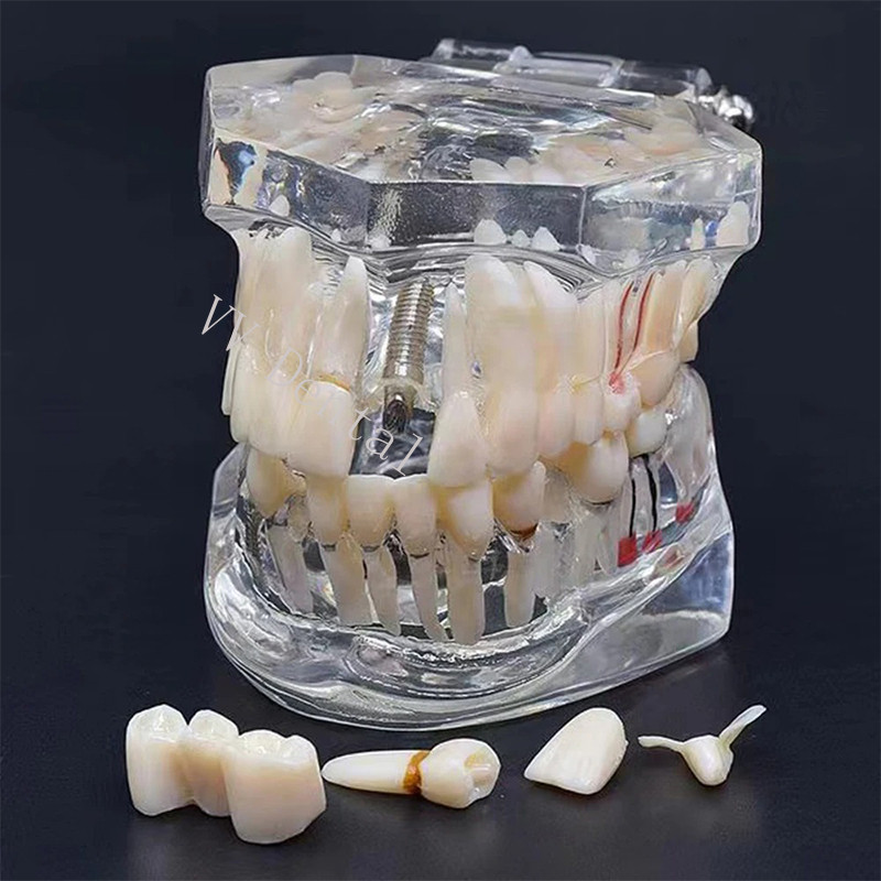 Dental Disease Model Teeth Teach Study Oral Teeth Bridge Restoration Pathology