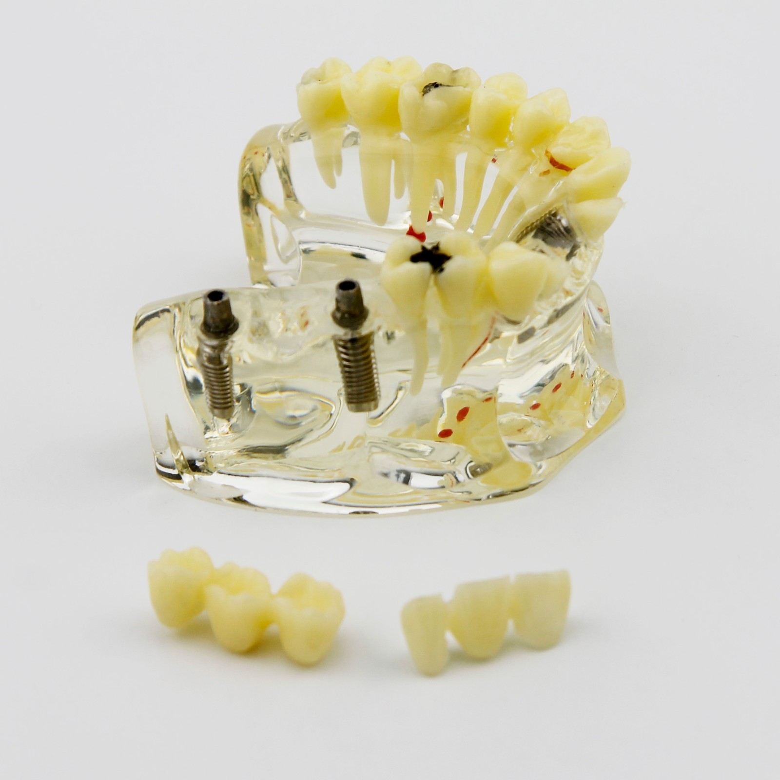 Dental Upper Jaw Implant Model with Bridge and Caries -I 2006