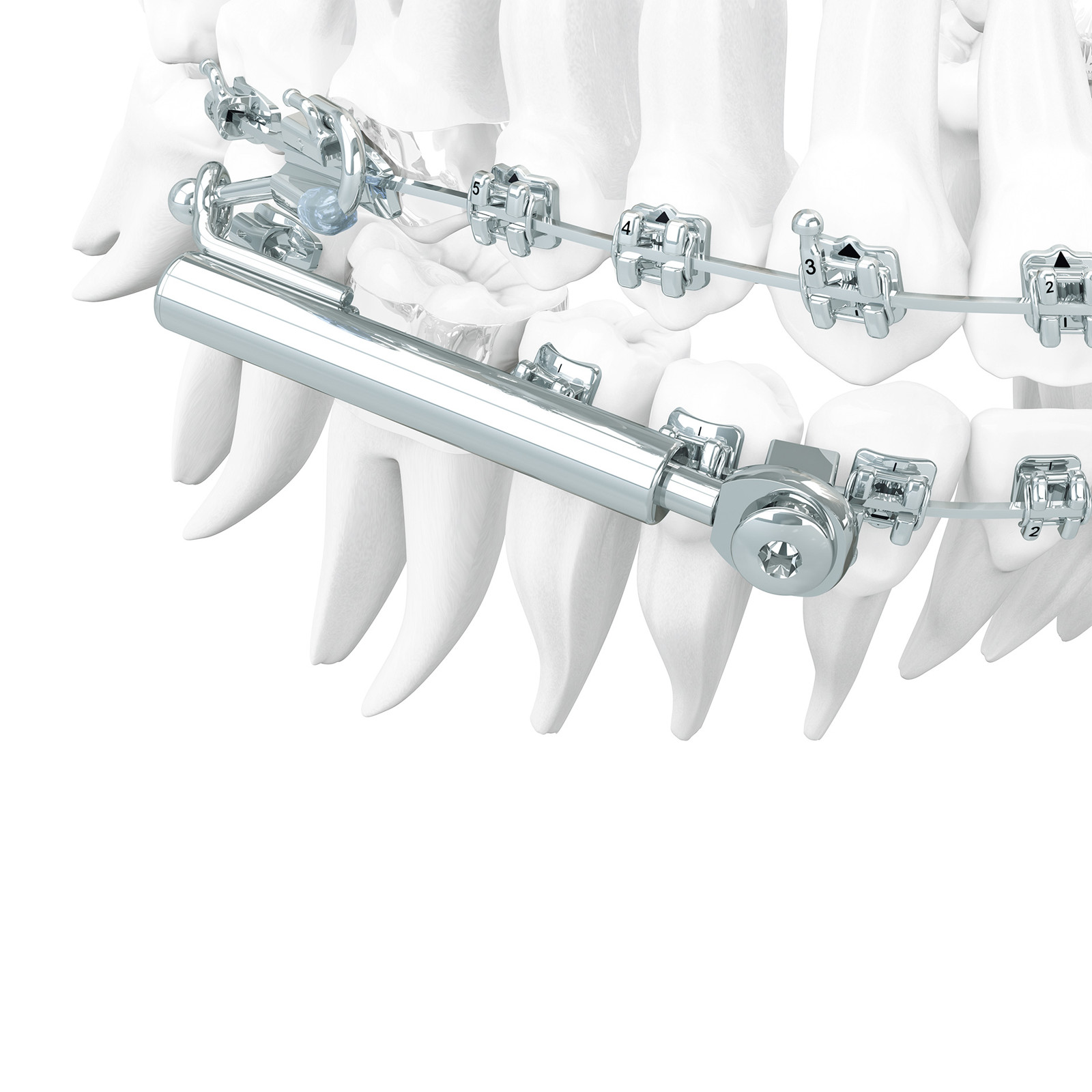 Dentaurum SUS³ Dental Orthodontic Sabbagh Universal Spring Application Set