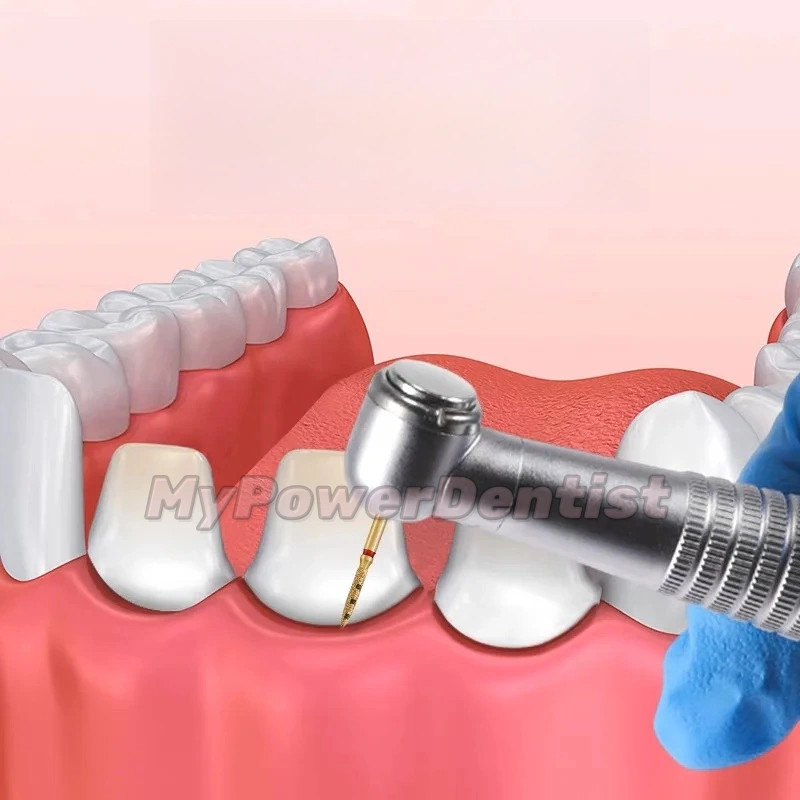 Dental Preparation Bur BOPT Kit Vertical Restoration Crown Restoration FG7906