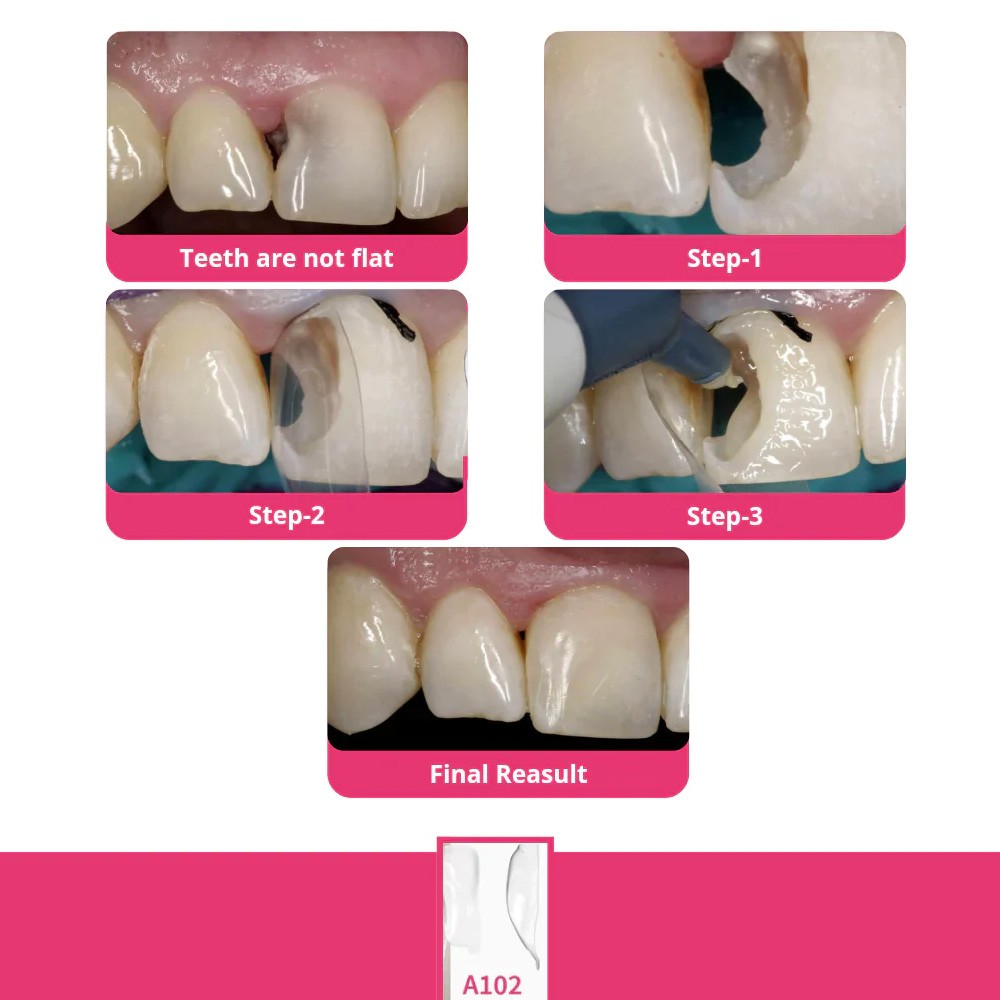 Bioclear Starter Matrix System mini Anterior Kit
