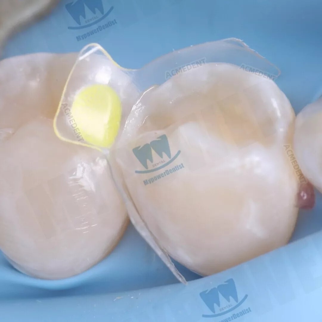 Dental Clear Matrix Diastema Matrices Wedges Similar with BioClear Matrice