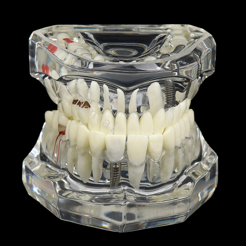 Dental Disease Model Teeth Teach Study Oral Teeth Bridge Restoration Pathology