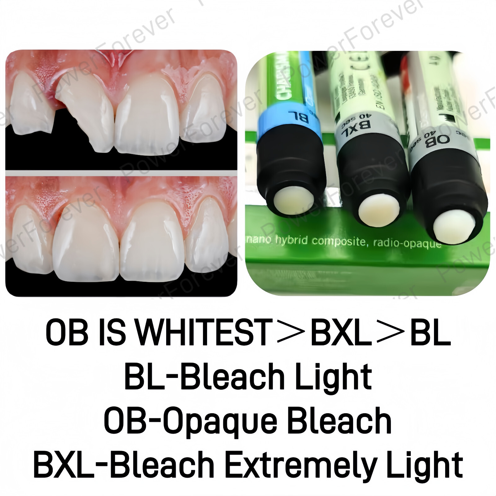 3Sizes Dental KULZER CHARISMA Composite Syringe Light Cure Resin OB/BL/BXL 4g/pc