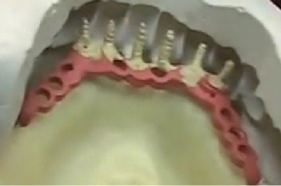 DSI Dental Lab Fixture OT Box Micro Castable Overdenture Ball Attachment Kit