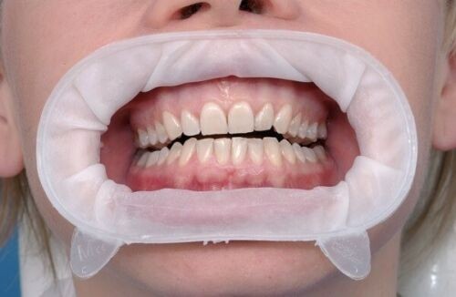 6 x Ivoclar OPTRAGATE 3D Mouth Opener Dental Cheek & Lip Retractor SMALL/REGULAR