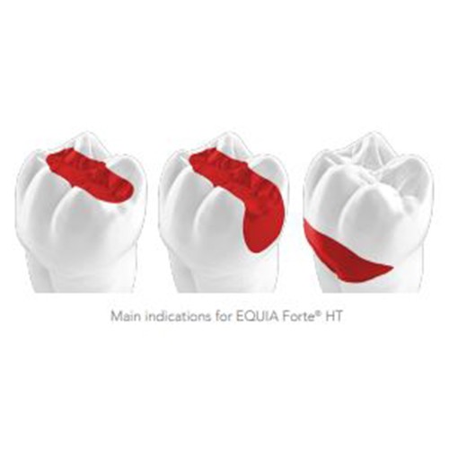 GC EQUIA Forte HT Capsule Bulk fill glass hybrid restorative system