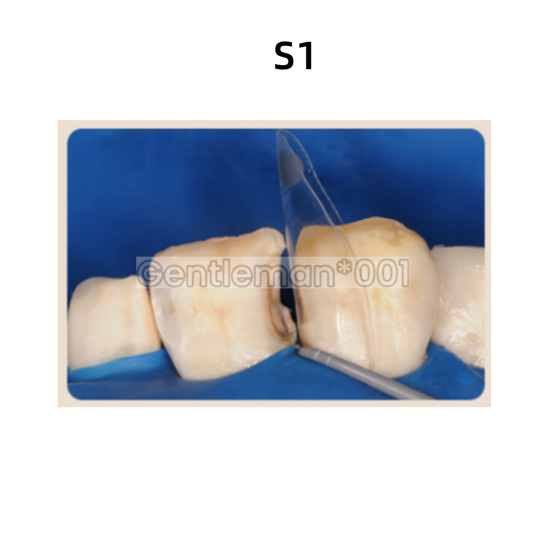Dental Widening Front Tranparent Clear Matrix BT Matrices Fits BioClear S1/2/3