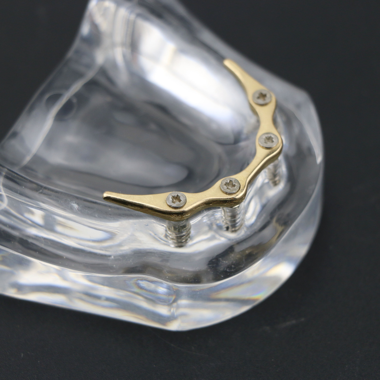 Dental Teeth Implant Model Inferior Overdenture 4 Implants Denture Demo Training