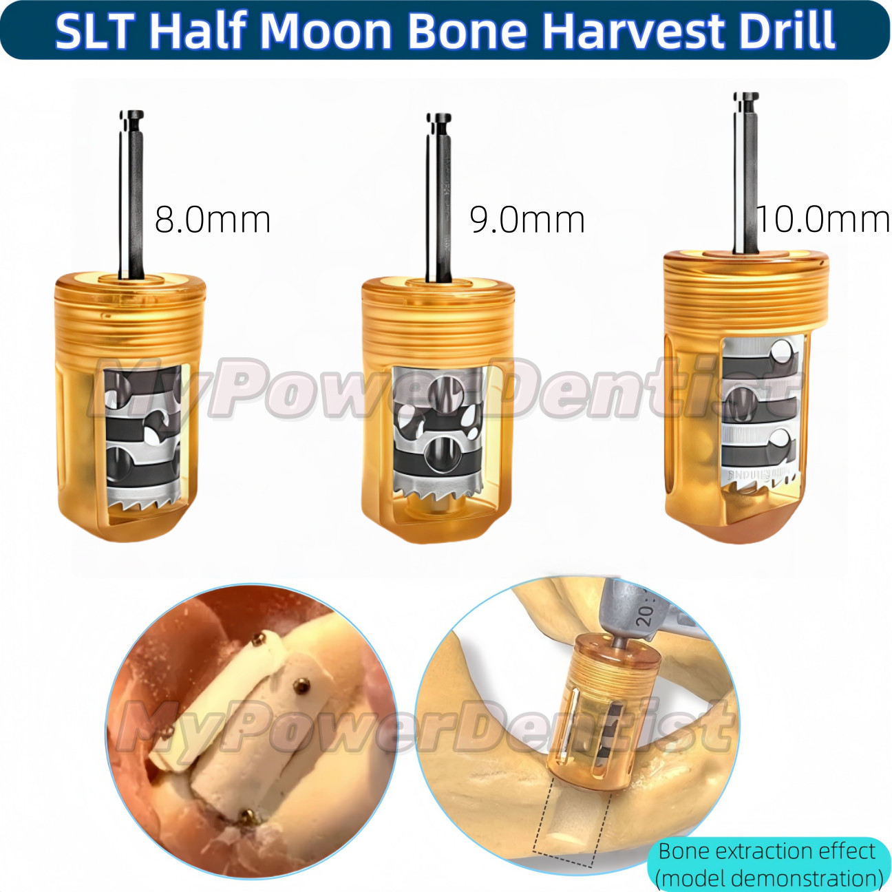 1Set Dental SLT Half Moon Bone Harvest Drill Semilunar Technique Collector Drill