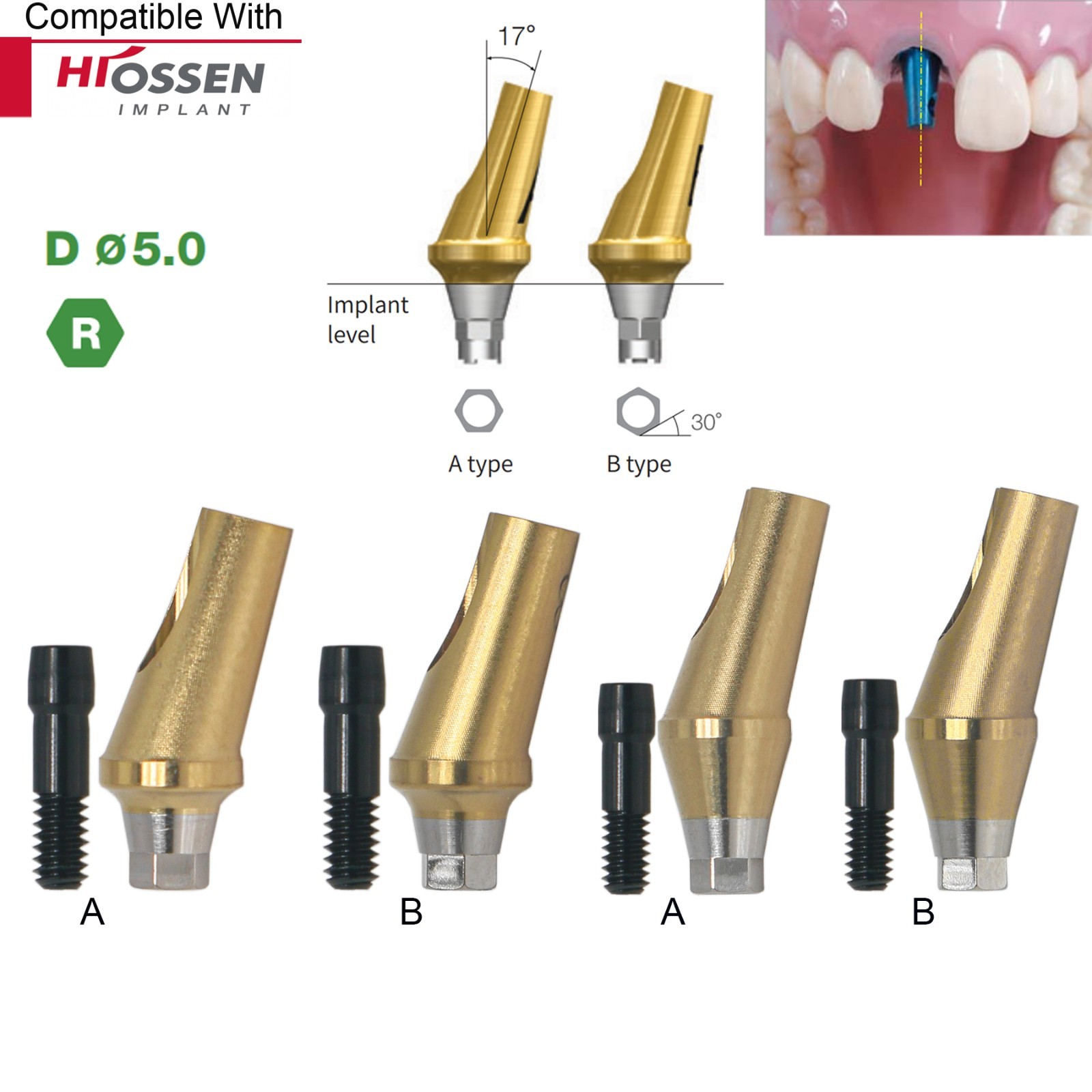 Dental 17° Angled Abutment Regular Ø5.0mm Hex A/B GH2/4 Fit Osstem TS Hiossen ET