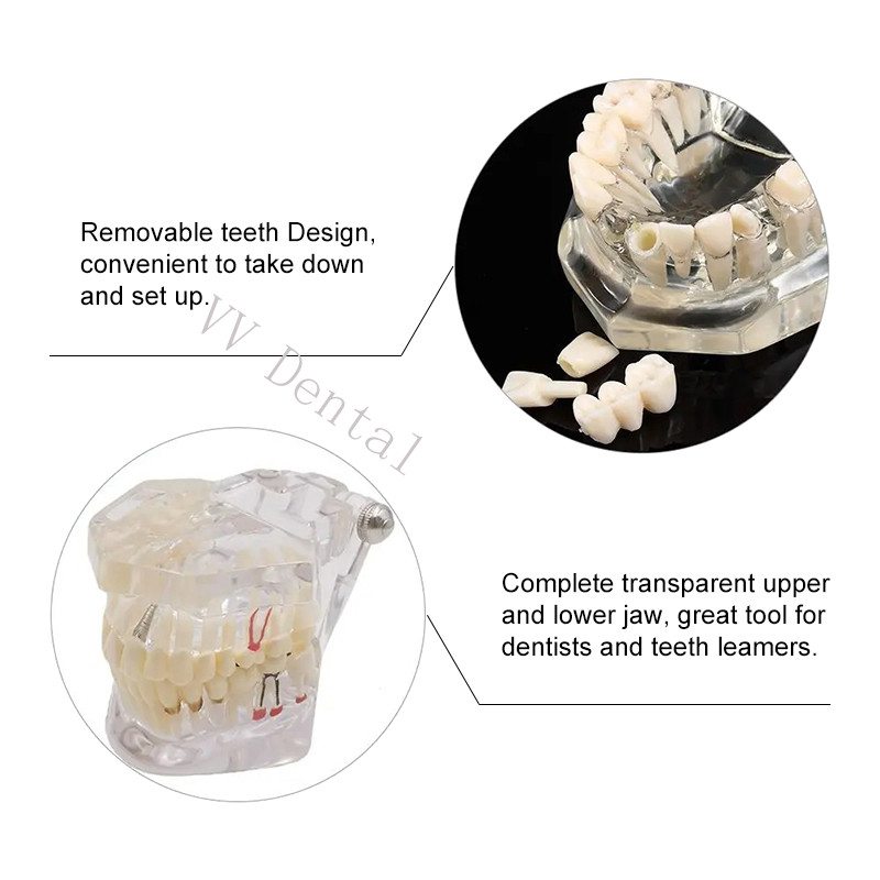 Dental Disease Model Teeth Teach Study Oral Teeth Bridge Restoration Pathology