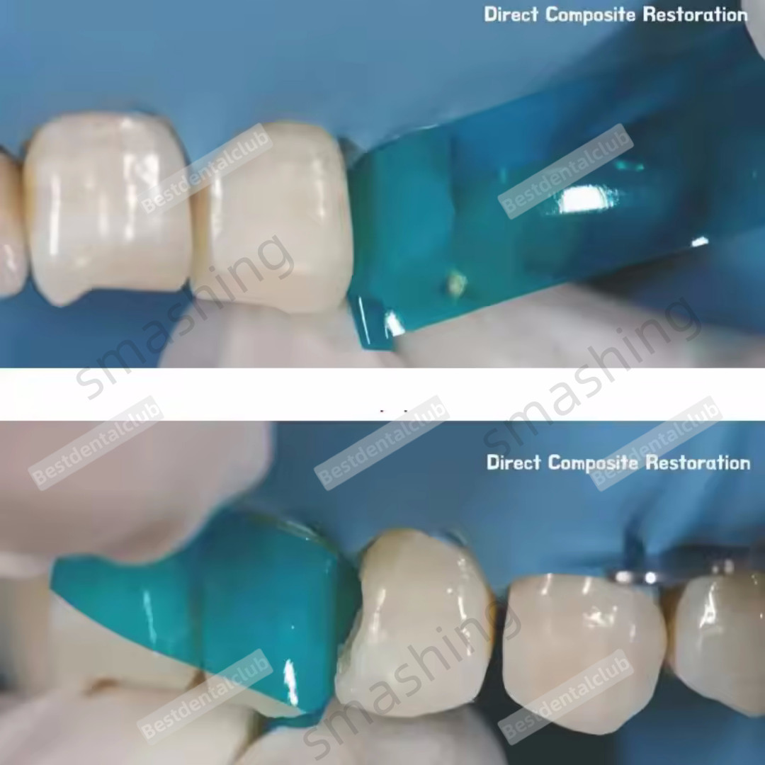 5Box Dental Blue View Matrix Contoured Anterior Matrices Mylar Anatomical Strip