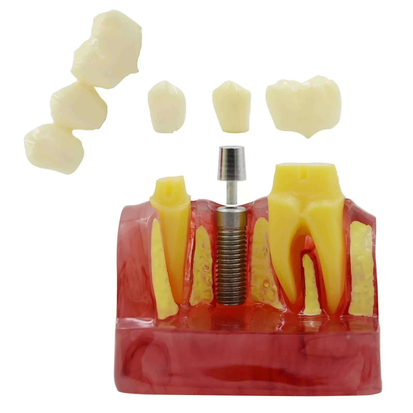 2Pc Dental Oral Analysis Crown Bridge Demonstration Tooth 4 Times Model Typodont