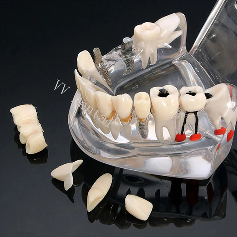 Dental Disease Model Teeth Teach Study Oral Teeth Bridge Restoration Pathology