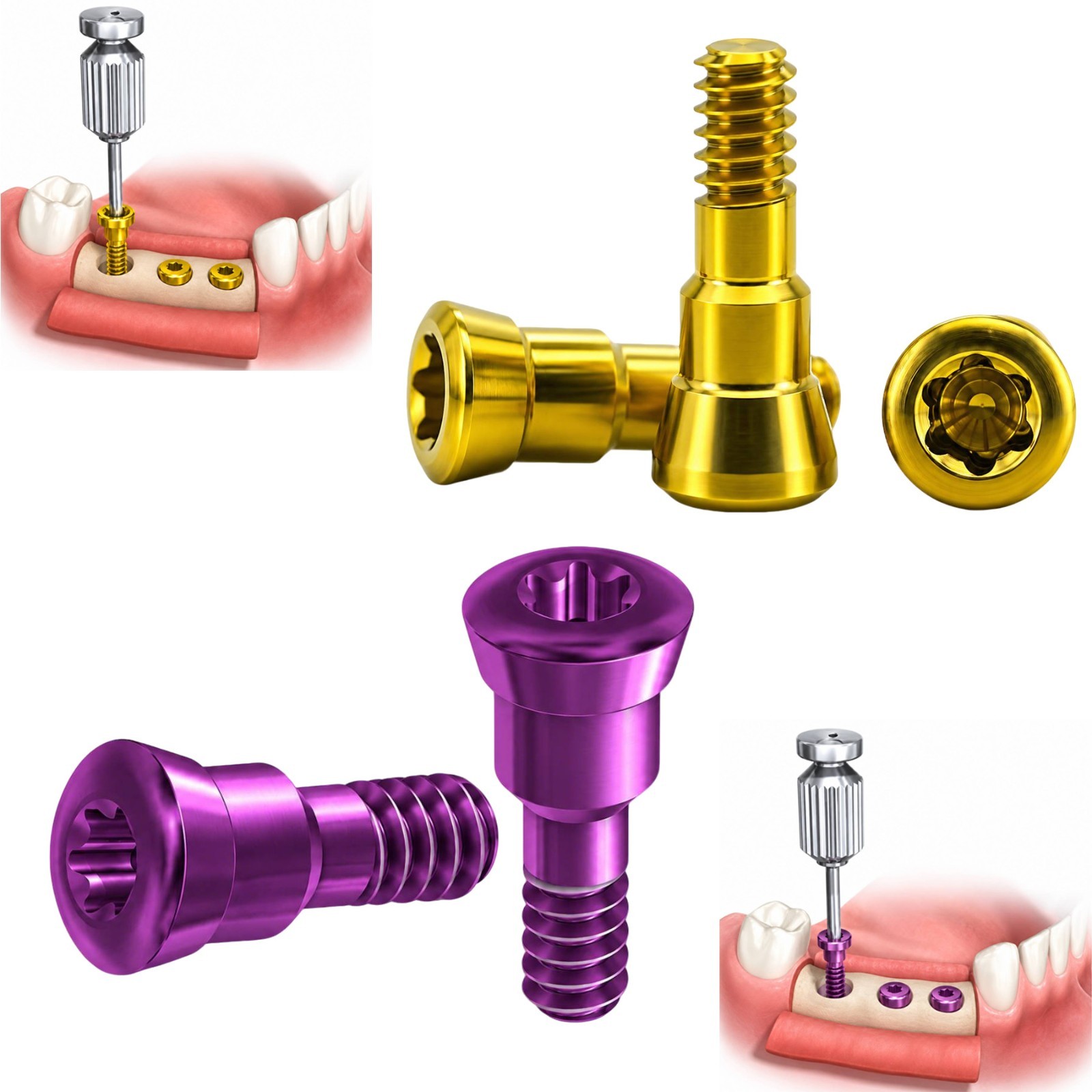 5Pcs ITI Titanium Healing Abutment & Closure Cap Screw Straumann BL / BLT NC/RC