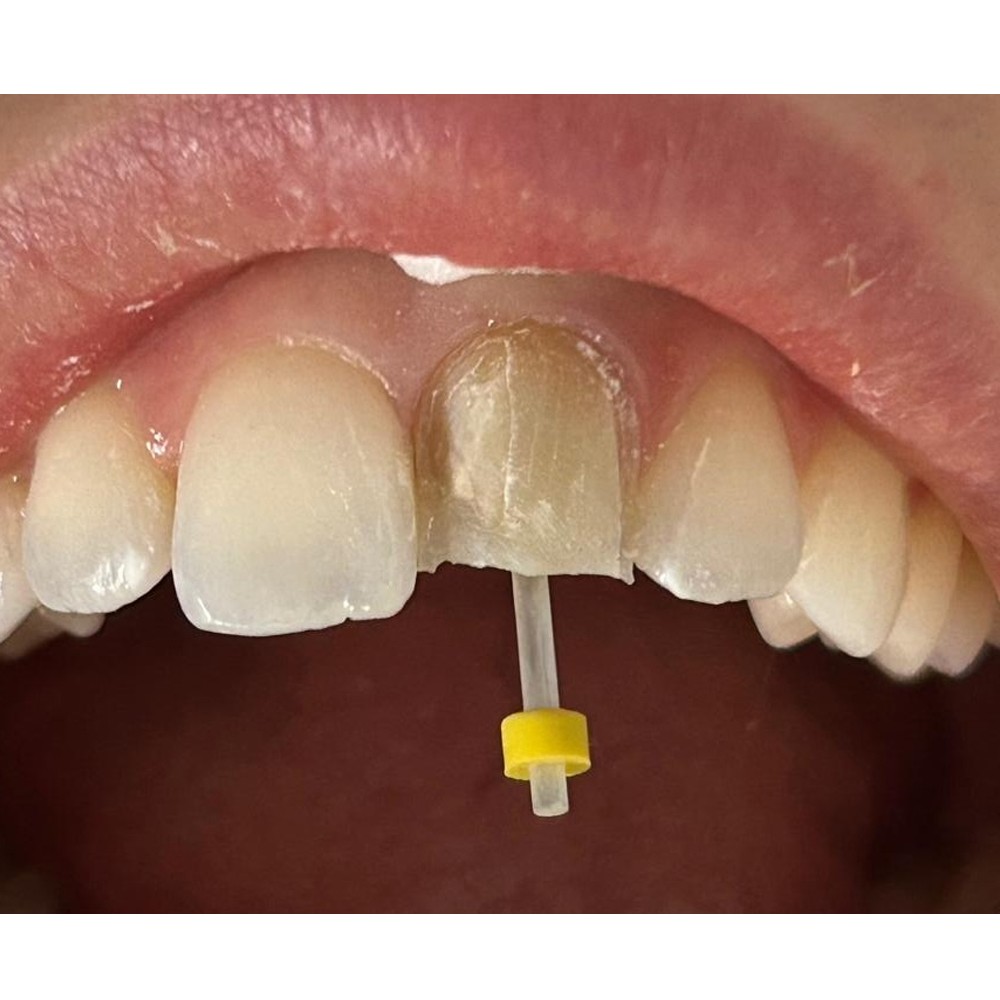 AAA Dental Fiber Post Kit (Pack of 20 Posts + 4 Drills)