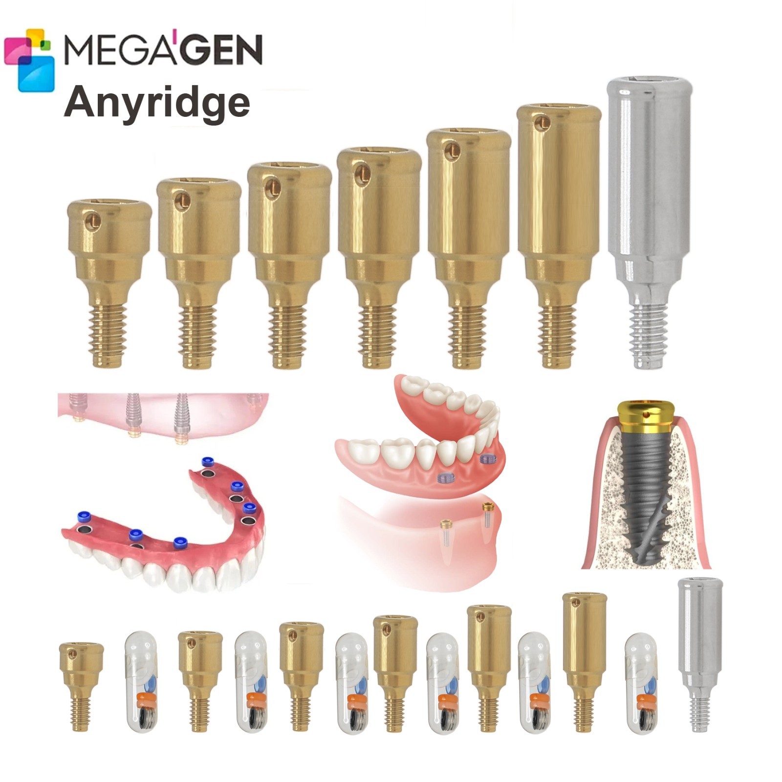 US Dental Locator Abutment Multiple Implant Hiosse/Nobel/Zimmer/BioHorizons/ITI