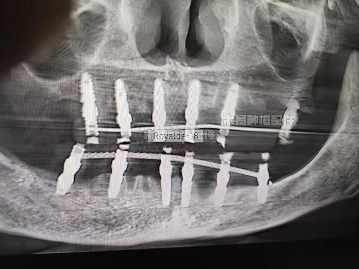 Dental Implan Connector Stainless Tianium Strengthener Wire Overdenture MU Wire