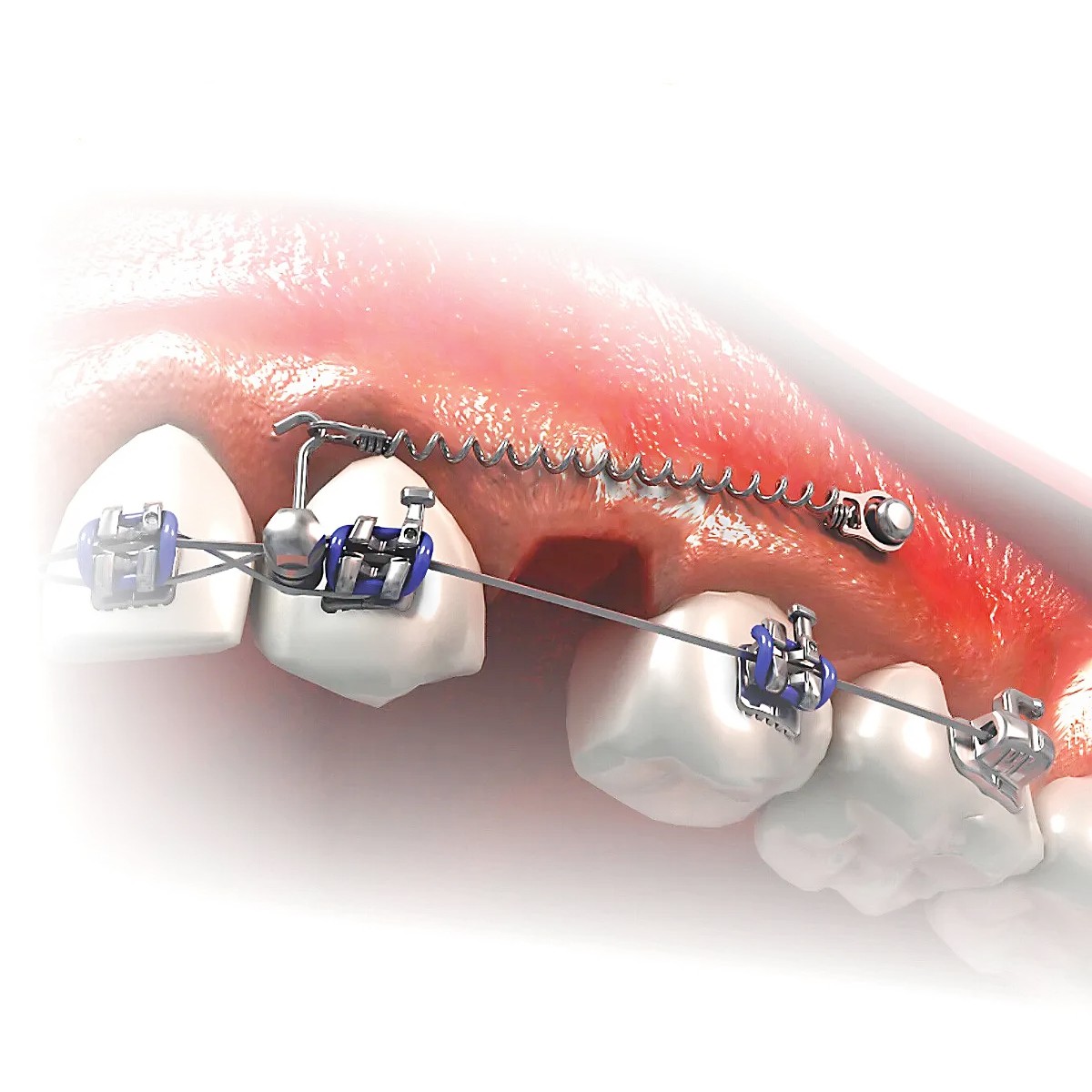JJ Ortho Orthox Titanium Mini Implant 1.4mm x 6mm (80.02.05)