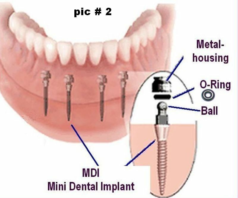 TOOL # 3 for mini dental implant rubber rings comes with 12 * o-rings size 3