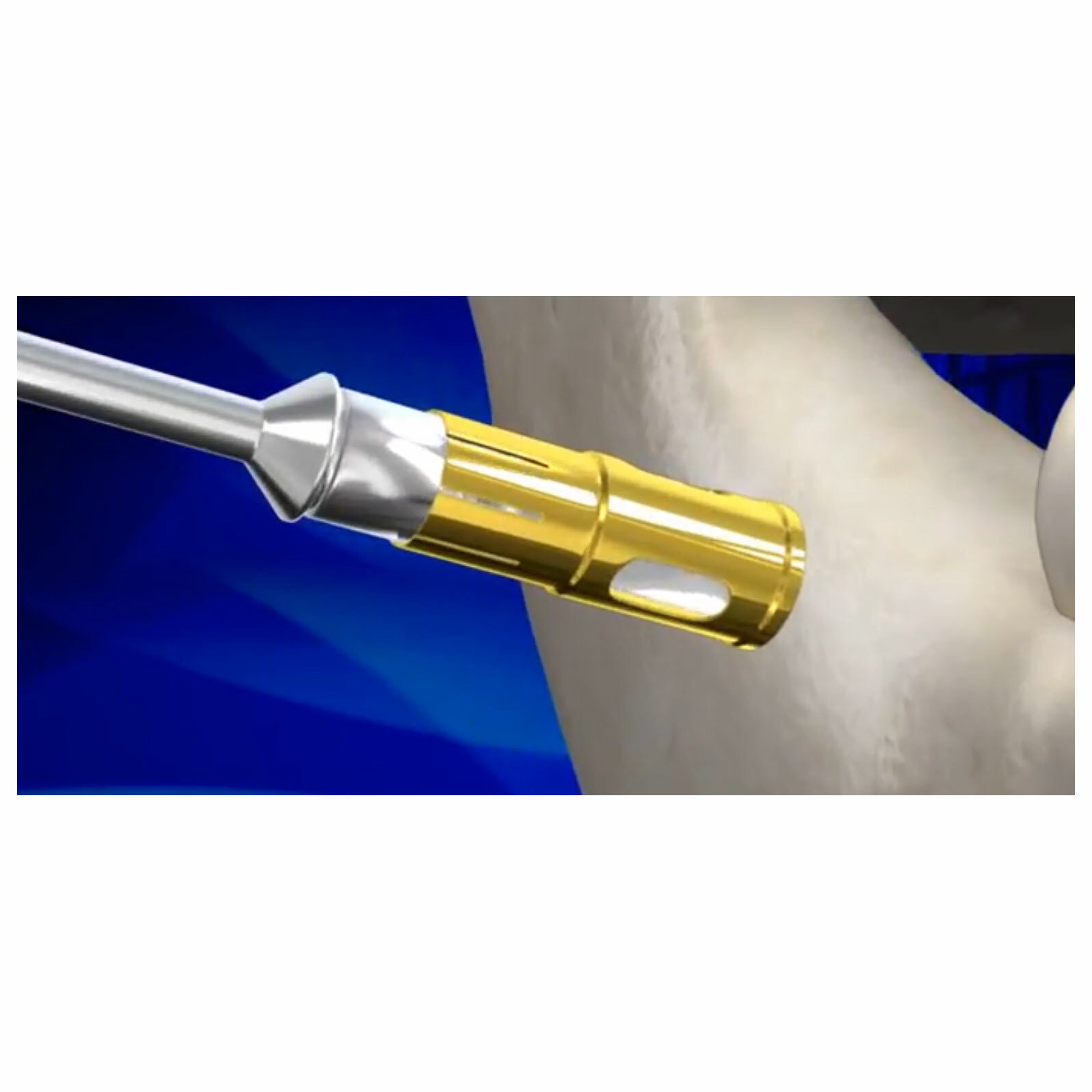 DSI NLBC Dental Implant Surgical Bone Graft Harvest Collector Augmentation 9Pcs