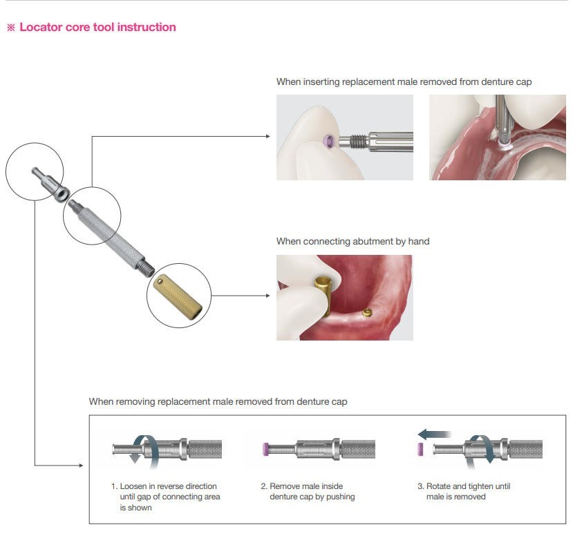 US Universal ZEST Locator PEEK Retention Cap Insertion Lab Core Extraction Tool