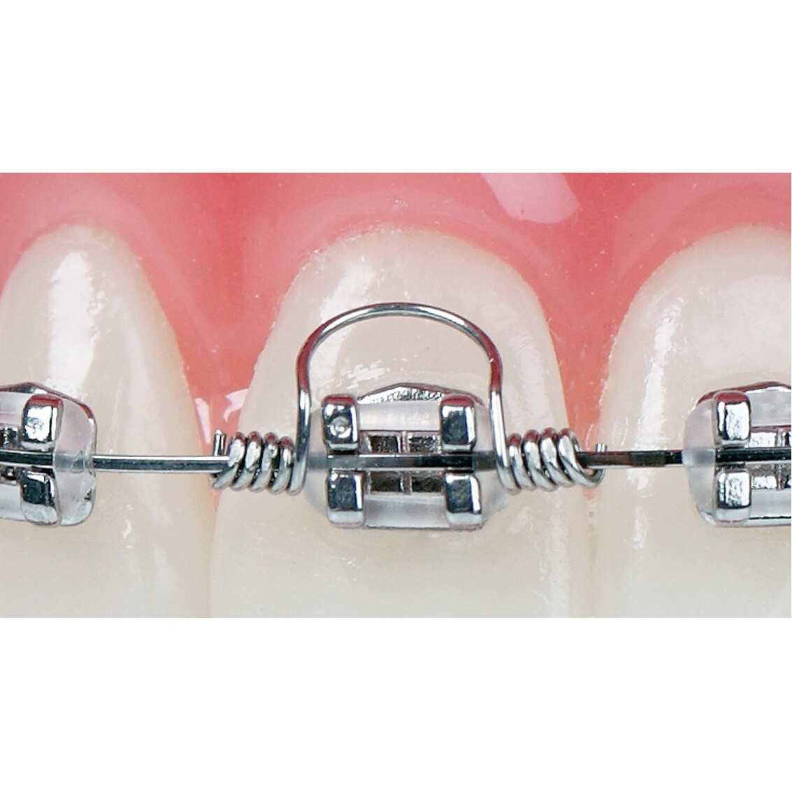 J&J Ortho™ Dental Orthodontic Archway Torquing Arch Spring (10/pk)