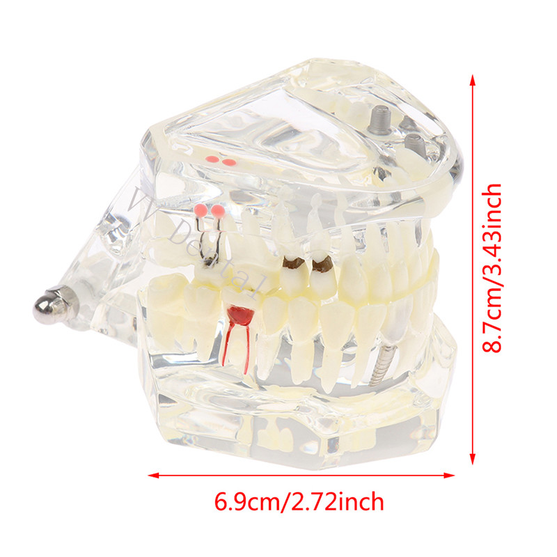 Dental Disease Model Teeth Teach Study Oral Teeth Bridge Restoration Pathology
