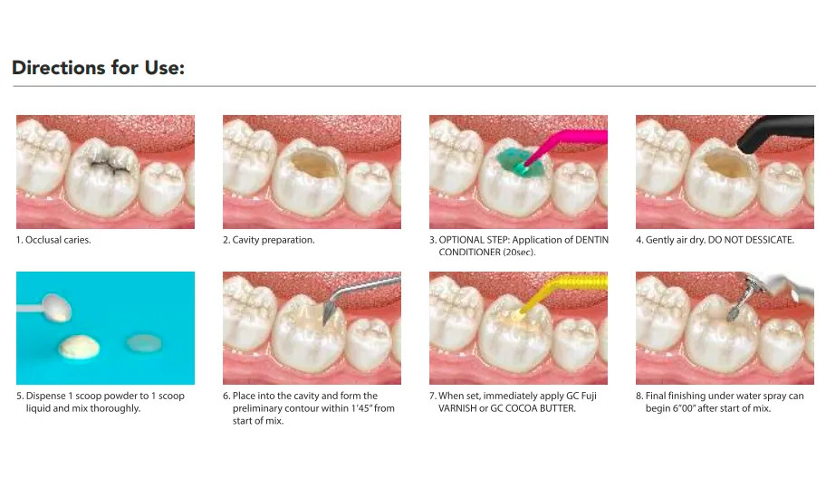 GC Gold Label Advanced Hybrid Technology Bulkfill High Strength Glass Ionomer.
