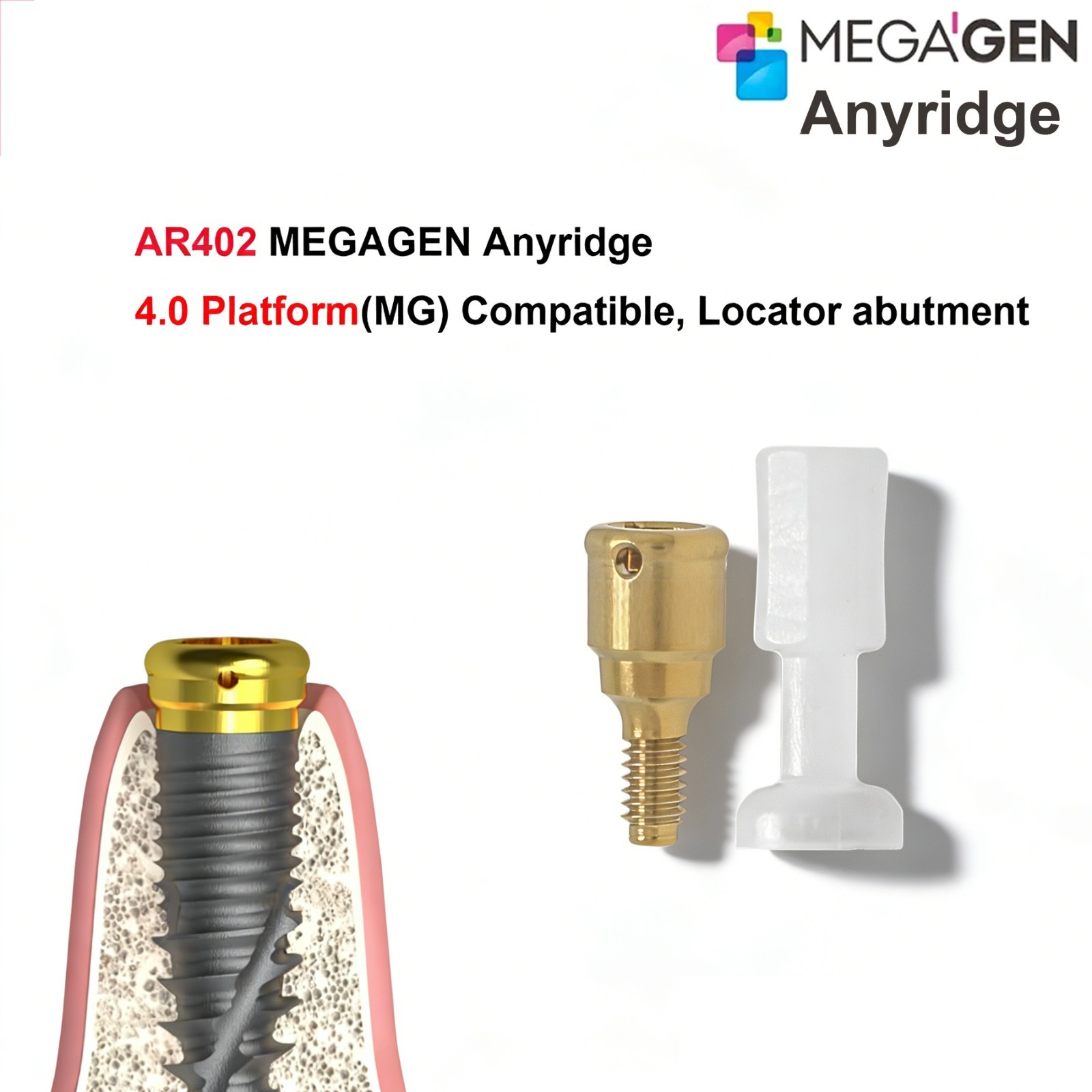 Zest Locator Overdenture Abutment Anchor For MEGAGEN AnyRidge AR Retention Caps
