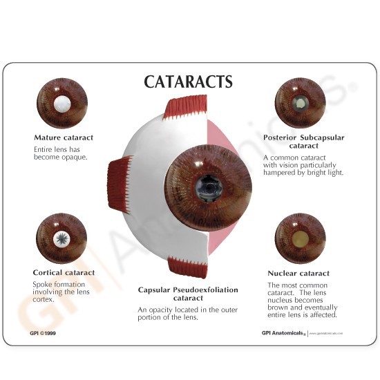 Eye Cataract Cornea Eye Set of 3 GPI Anatomy Models #4021 Make Offer! SEE VIDEO