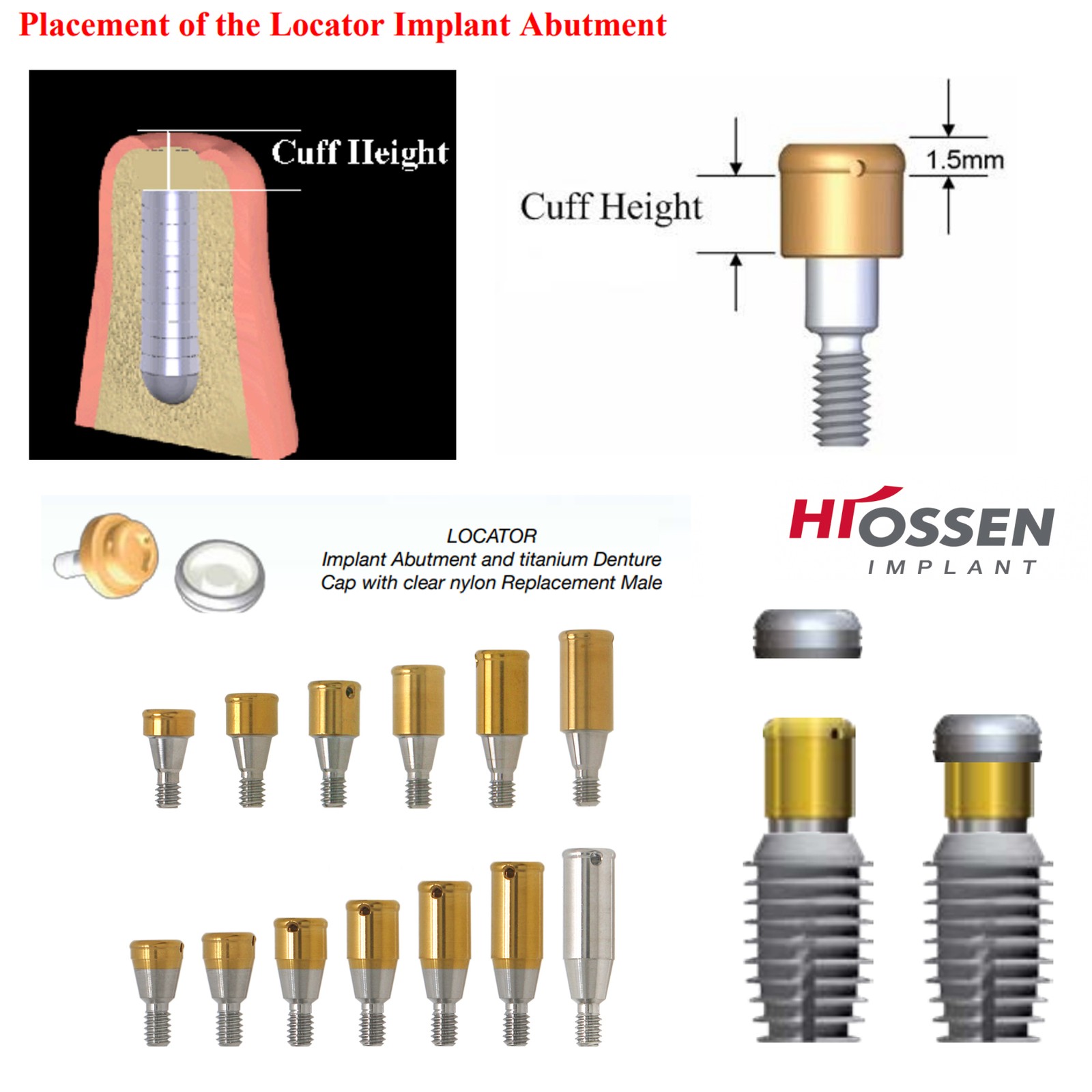 US Dental Locator Overdenture Abutment & Caps Fits Nobel/Hiossen/Zimmer/MIS/TSV