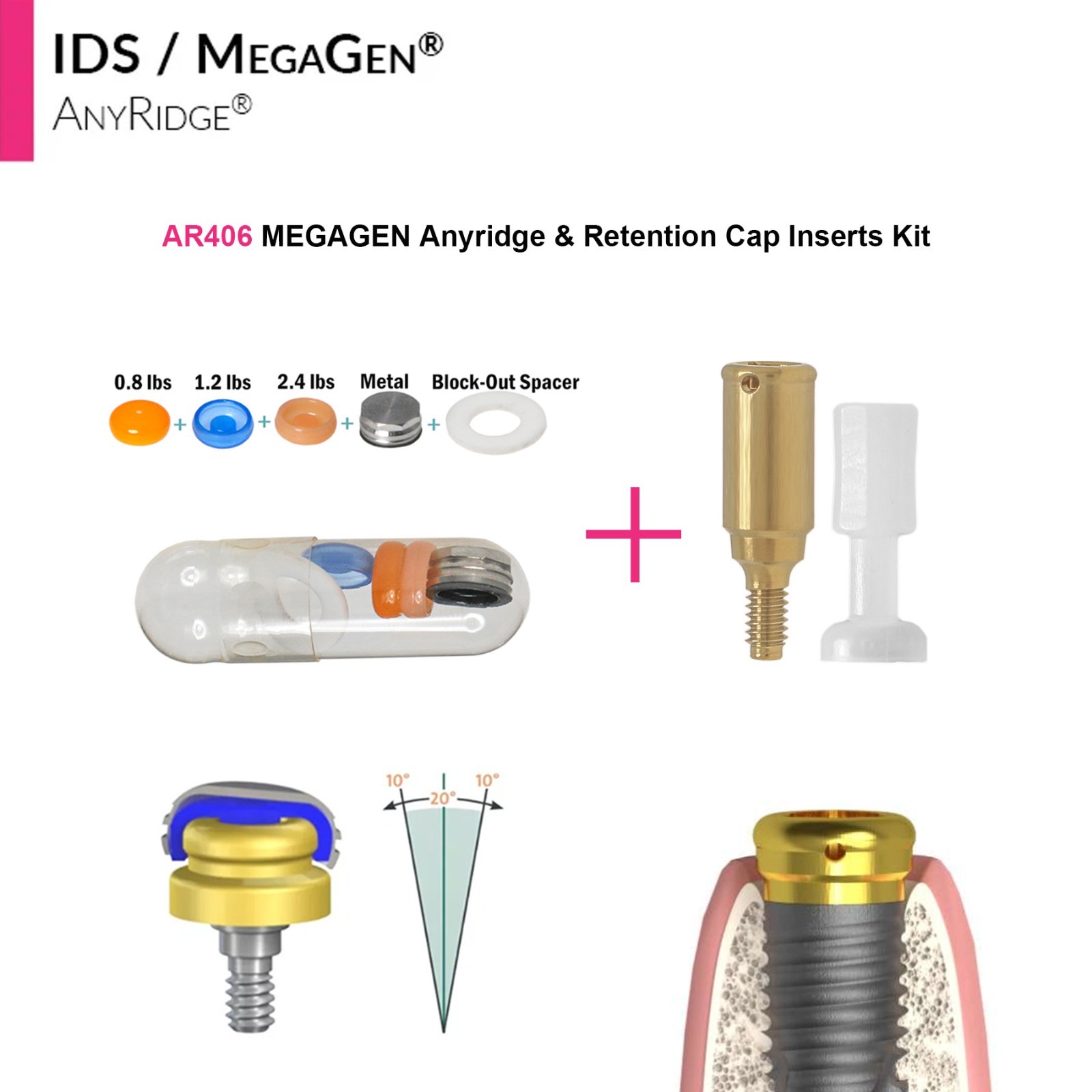 Zest Locator Overdenture Abutment Anchor For MEGAGEN AnyRidge AR Retention Caps