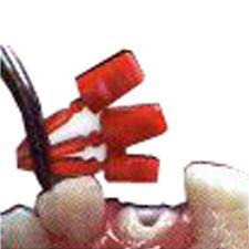 Nucleojet Root Canal Prefabricated Polycarbonate Structure (Structure Pins) 17pc